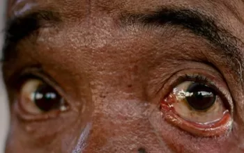 Na fila, 562 pacientes aguardam cirurgia para não ficarem cegos