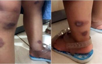 Bebê é resgatada após ser queimada com ponta de cigarro por padrasto