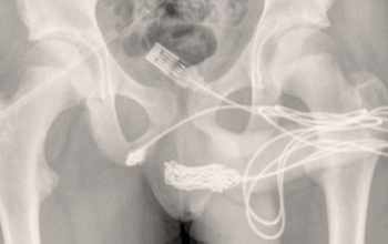 Garoto de 15 anos enfia cabo USB para medir o pênis é submetido a cirurgia