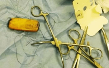 Homem engole celular e precisa fazer cirurgia por não conseguir evacuar