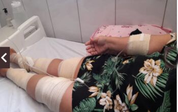 Vídeo: ataque feroz de cachorros deixa mulher com pernas dilaceradas