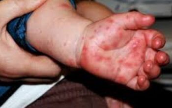 Alerta: Goiânia identifica casos de síndrome “mão-pé-boca” em crianças