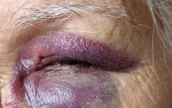 Idosa de 65 anos é agredida a pauladas, chutes e murros