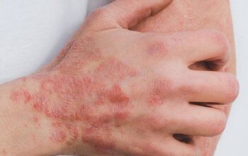 Pesquisadores veem ligação entre surto de sarna e uso de ivermectina