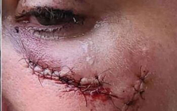 Empresária é agredida pelo ex-namorado em frente a bar