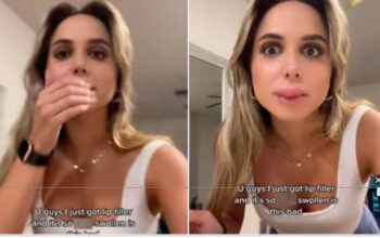 Mulher fica com “boca de peixe” após preenchimento labial. Veja vídeo