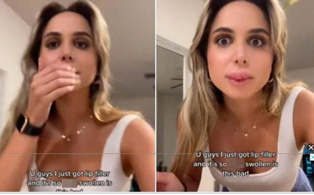 Mulher fica com “boca de peixe” após preenchimento labial. Veja vídeo