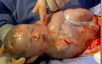 Vídeo de médico rompendo bolsa de bebê que nasceu empelicado viraliza