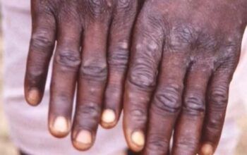 Sauna é interditada em Madri por suspeita de varíola dos macacos