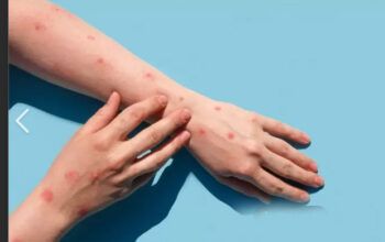 Saúde confirma 76 casos de varíola dos macacos em sete estados;  Amazonas investiga casos suspeitos