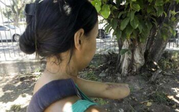 Mulher que se internou para ter bebê e saiu do hospital com mão e punho amputados