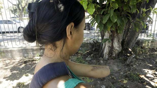Mulher que se internou para ter bebê e saiu do hospital com mão e punho amputados
