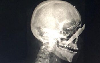 Bêbado crava faca no rosto de homem e é linchado em Carauari