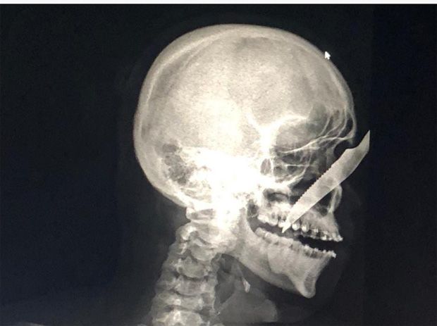 Bêbado crava faca no rosto de homem e é linchado em Carauari