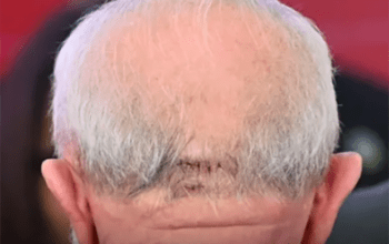 Com cicatriz na cabeça, Lula participa de primeiro evento após queda