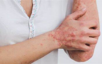  Esporotricose humana no Amazonas chega a 1.078 casos, segundo boletim FVS-RCP 