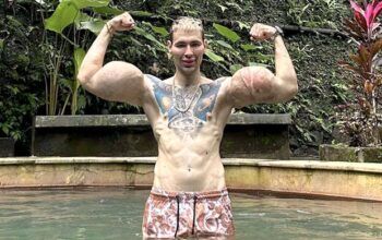 'Popeye russo' corre risco de perder os braços após injetar substância perigosa