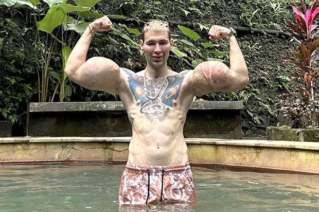 'Popeye russo' corre risco de perder os braços após injetar substância perigosa