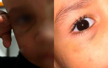 Avó relata maus-tratos contra bebê em creche: “Bumbum em carne viva”