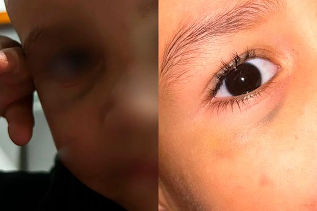 Avó relata maus-tratos contra bebê em creche: “Bumbum em carne viva”