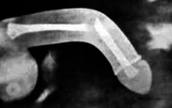 Fraturas penianas aumentam entre 24 e 26 de dezembro, aponta estudo