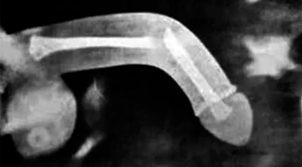 Fraturas penianas aumentam entre 24 e 26 de dezembro, aponta estudo