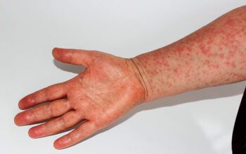 Sarampo: após novo caso em SP, governo reforça importância da vacina