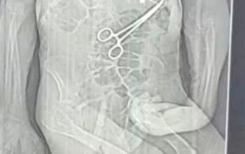 Homem e 68 anos morre na véspera do Natal após pinça ser deixada no corpo em cirurgia