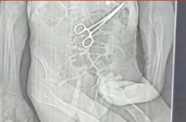 Homem e 68 anos morre na véspera do Natal após pinça ser deixada no corpo em cirurgia