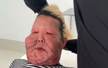 Médico mostra óleo mineral tirado de Juju do Pix em cirurgia