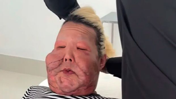 Médico mostra óleo mineral tirado de Juju do Pix em cirurgia