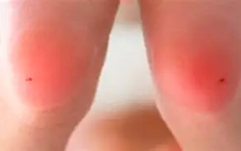 Anvisa aprova novo medicamento para tratar fenilcetonúria