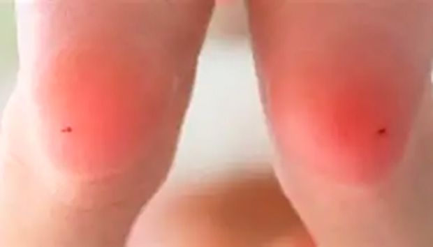 Anvisa aprova novo medicamento para tratar fenilcetonúria