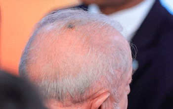 Lula passa por procedimento médico e aparece com cicatriz