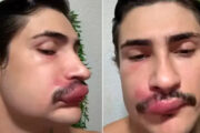 Influencer Ken de CG está internado após espremer espinha no “triângulo da morte”