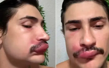 Influencer Ken de CG está internado após espremer espinha no “triângulo da morte”