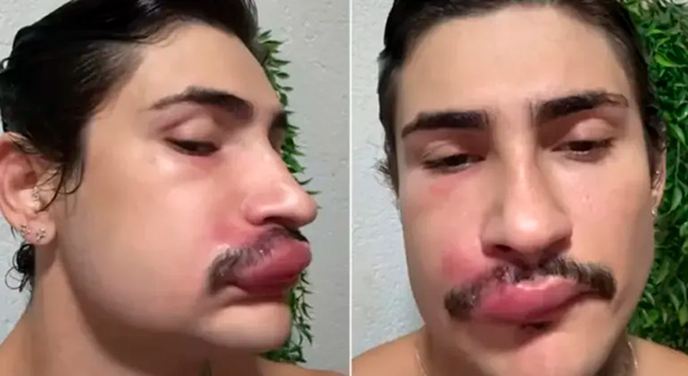 Influencer Ken de CG está internado após espremer espinha no “triângulo da morte”