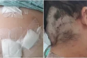 “Fingi que estava morta”: mulher sobrevive a 12 facadas do ex