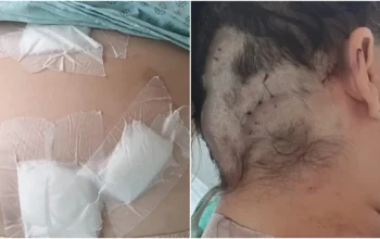 “Fingi que estava morta”: mulher sobrevive a 12 facadas do ex