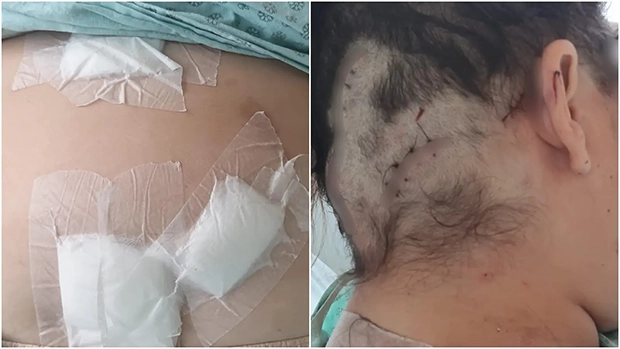 “Fingi que estava morta”: mulher sobrevive a 12 facadas do ex