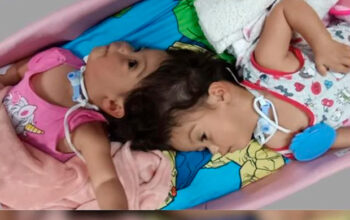 Gêmeas siamesas unidas pela cabeça morrem em cirurgia de separação