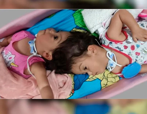 Gêmeas siamesas unidas pela cabeça morrem em cirurgia de separação